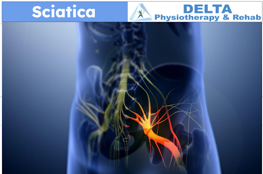 A poster for delta physiotherapy and rehab shows a person with sciatica