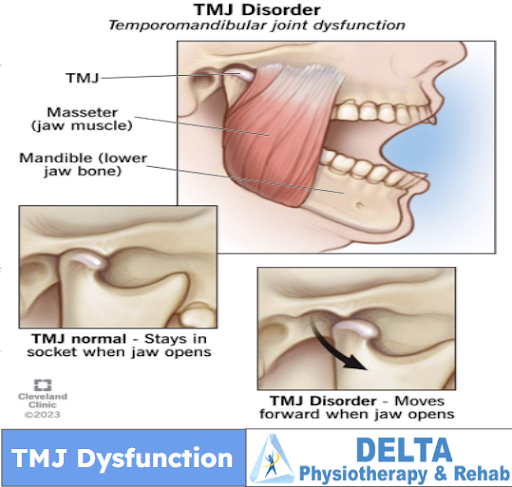 A diagram of a tmj disorder with a delta logo