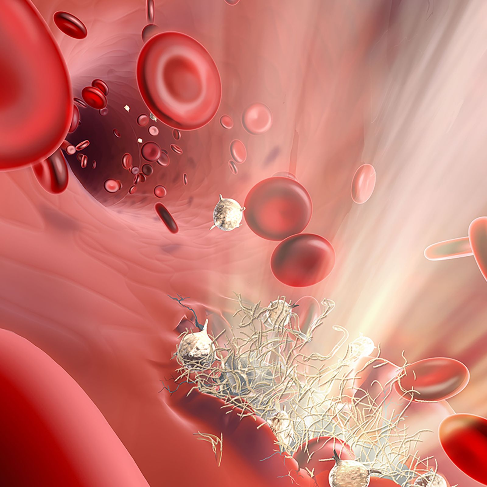 Illustration of a blood clot