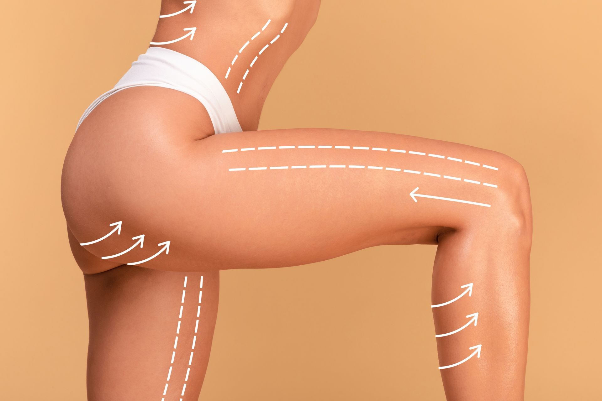 A person’s lower body with white dashed lines and arrows indicating areas for potential cosmetic treatment or contouring.