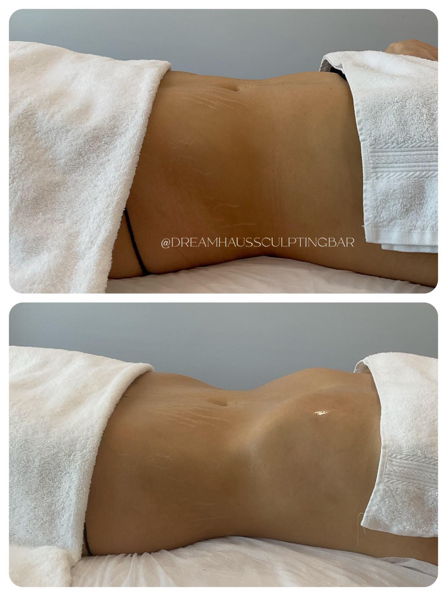 A woman is laying on a bed with a towel on her stomach.