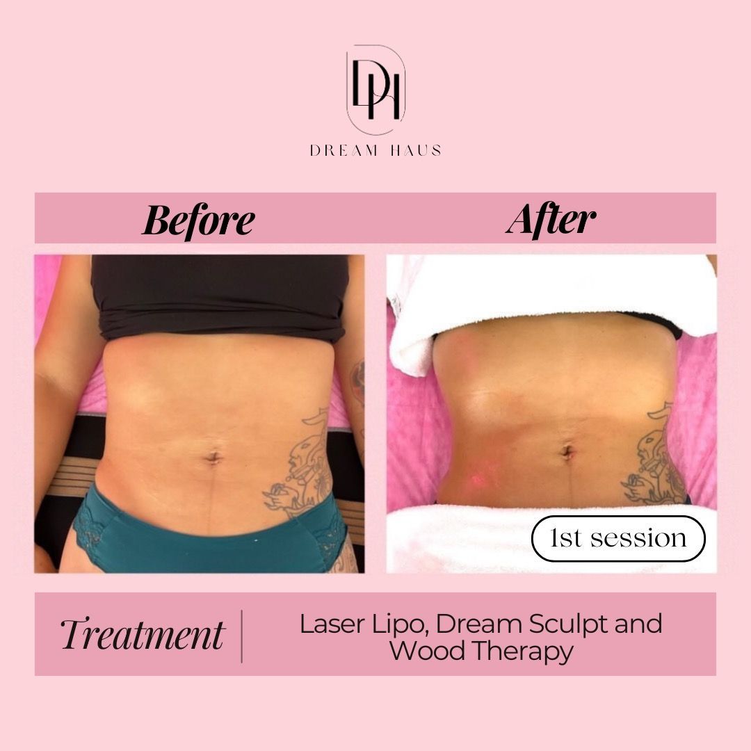 A before and after photo of a woman 's stomach.