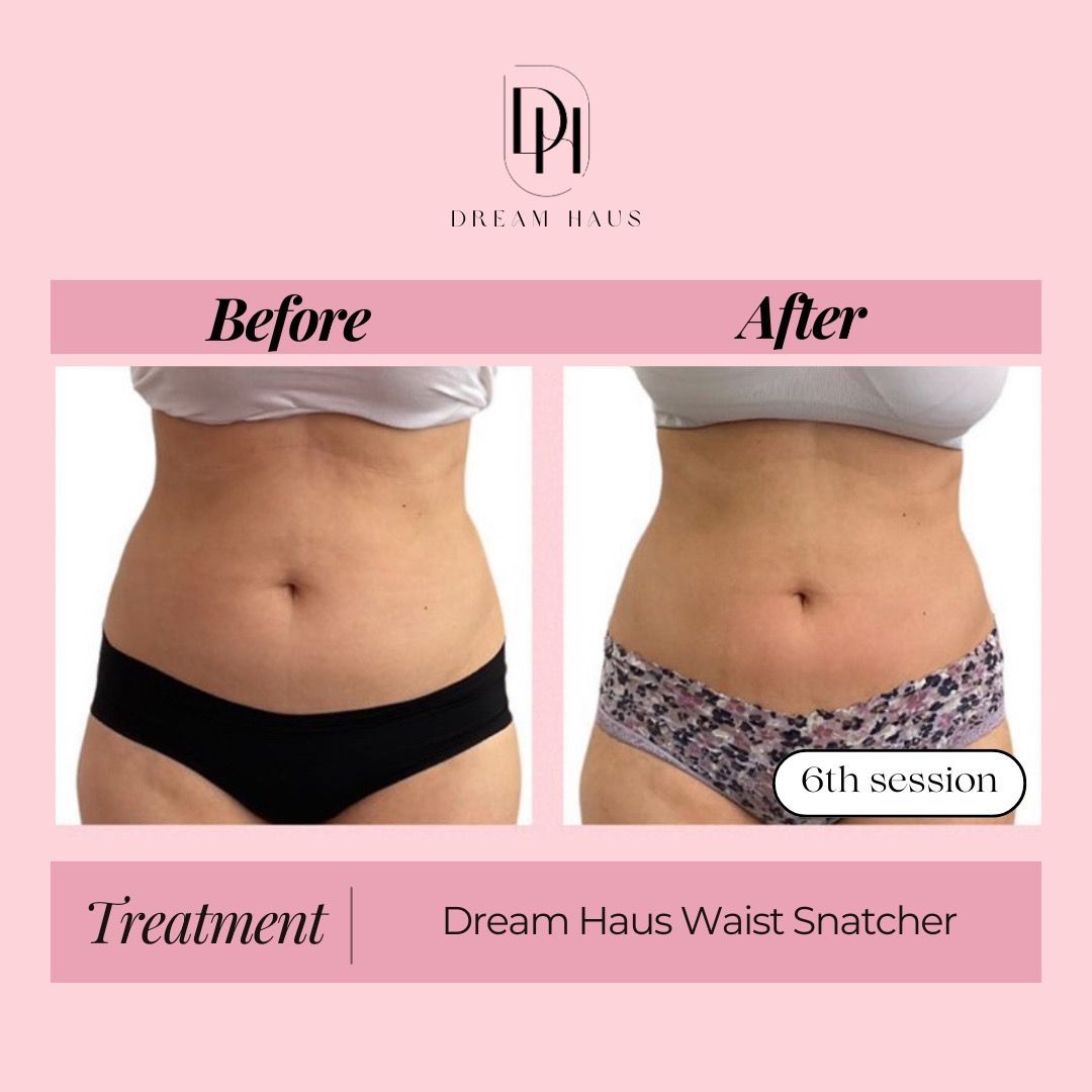 A before and after picture of a woman 's stomach.