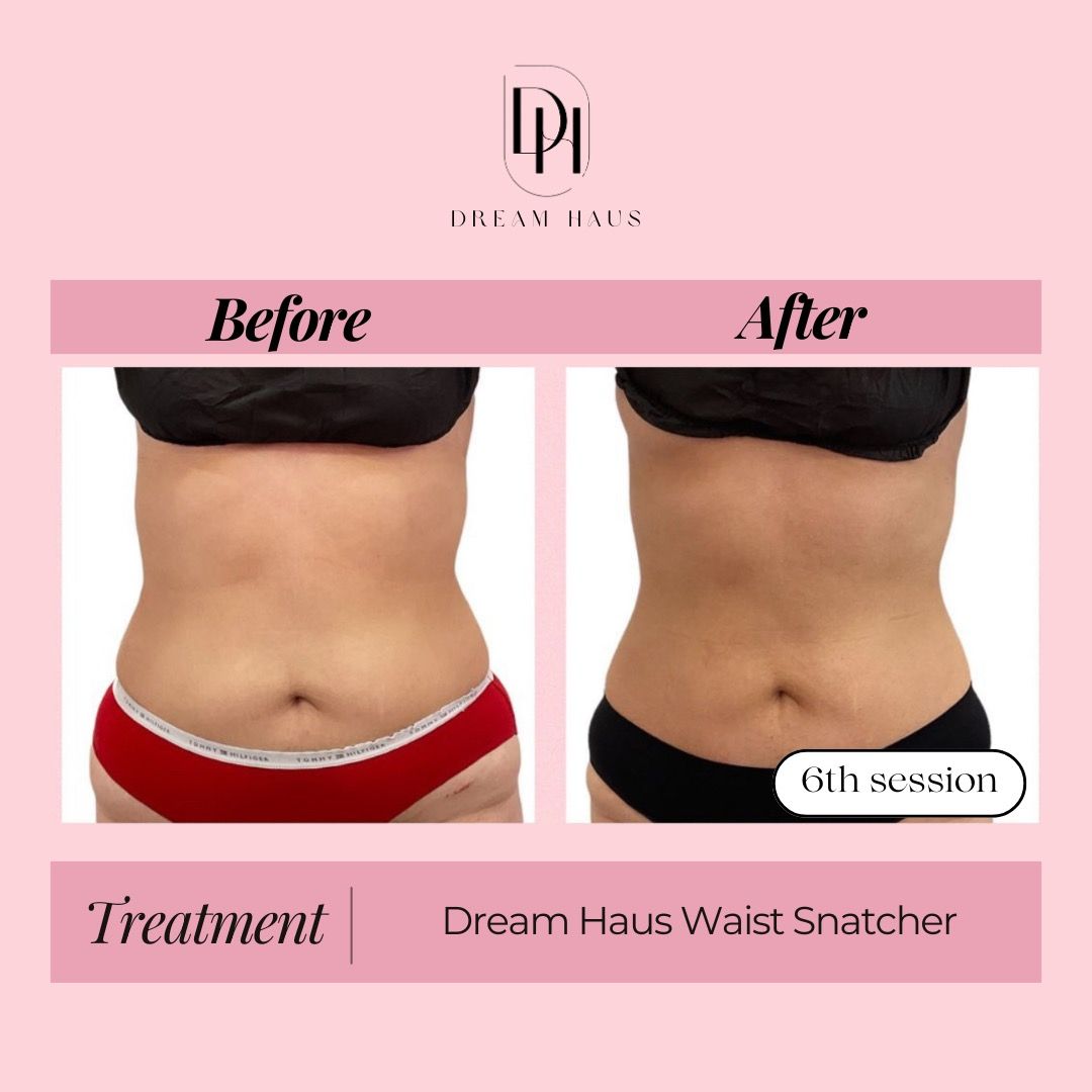 A before and after picture of a woman 's stomach.