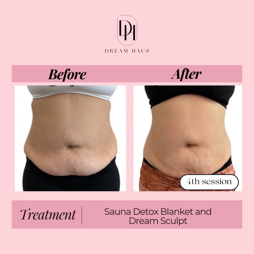 A before and after photo of a woman 's stomach.