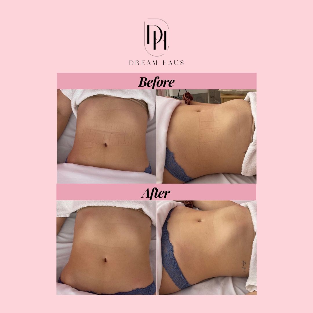 A woman 's stomach is shown before and after a treatment.