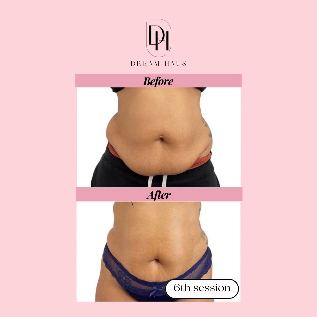 A before and after picture of a woman 's stomach.