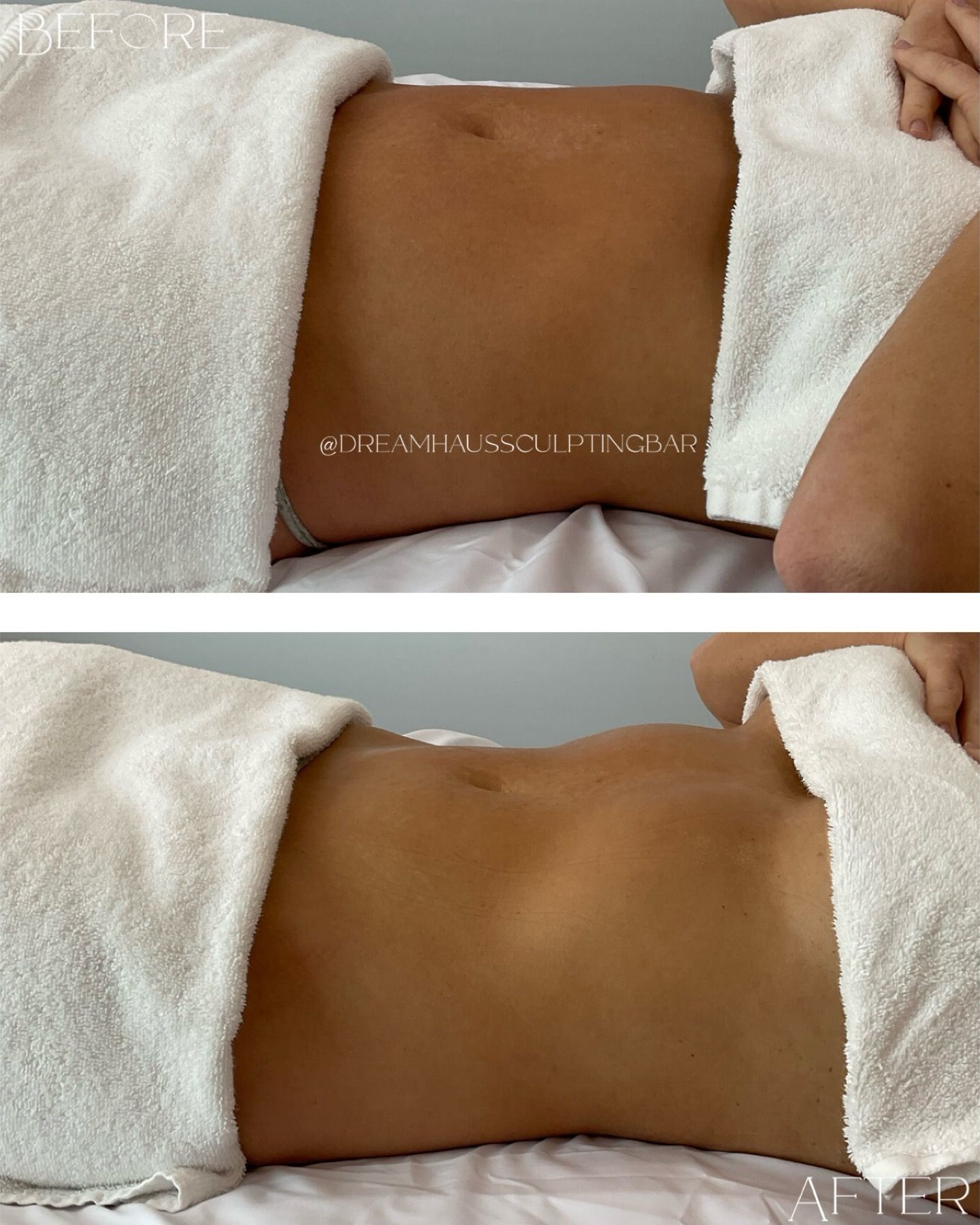 A woman is laying on a bed with a towel on her stomach.