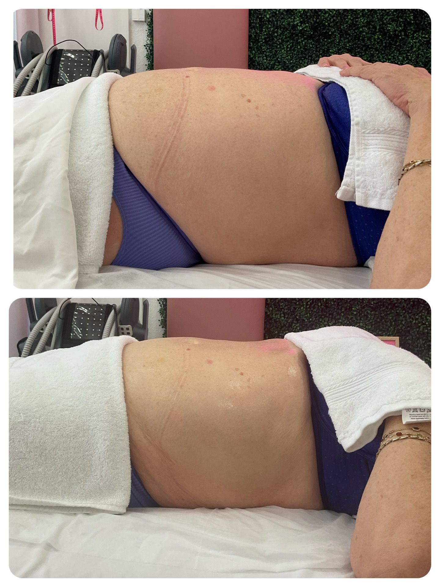 A woman laying on a bed with a towel on her stomach