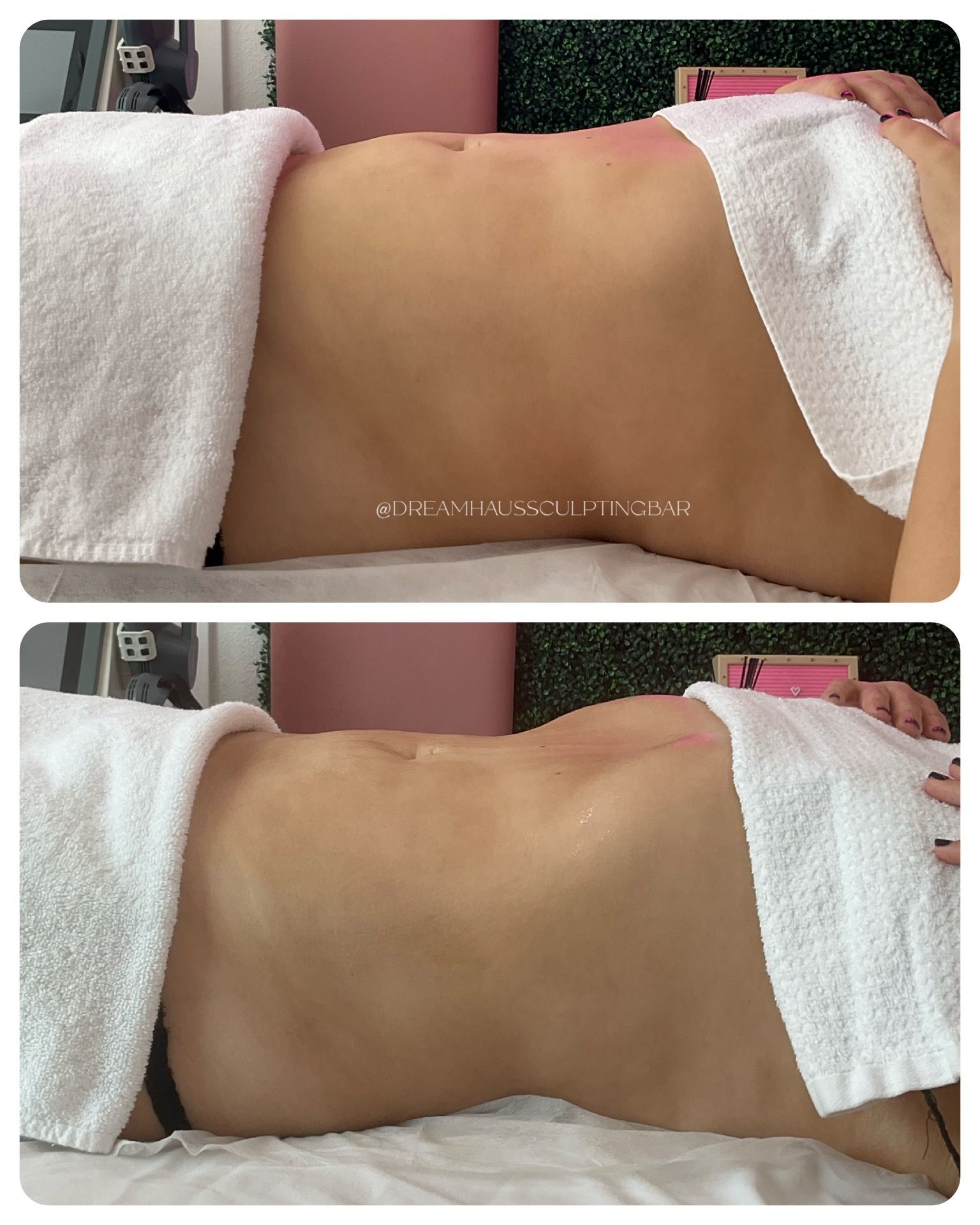 A woman is laying on a bed with a towel on her stomach.