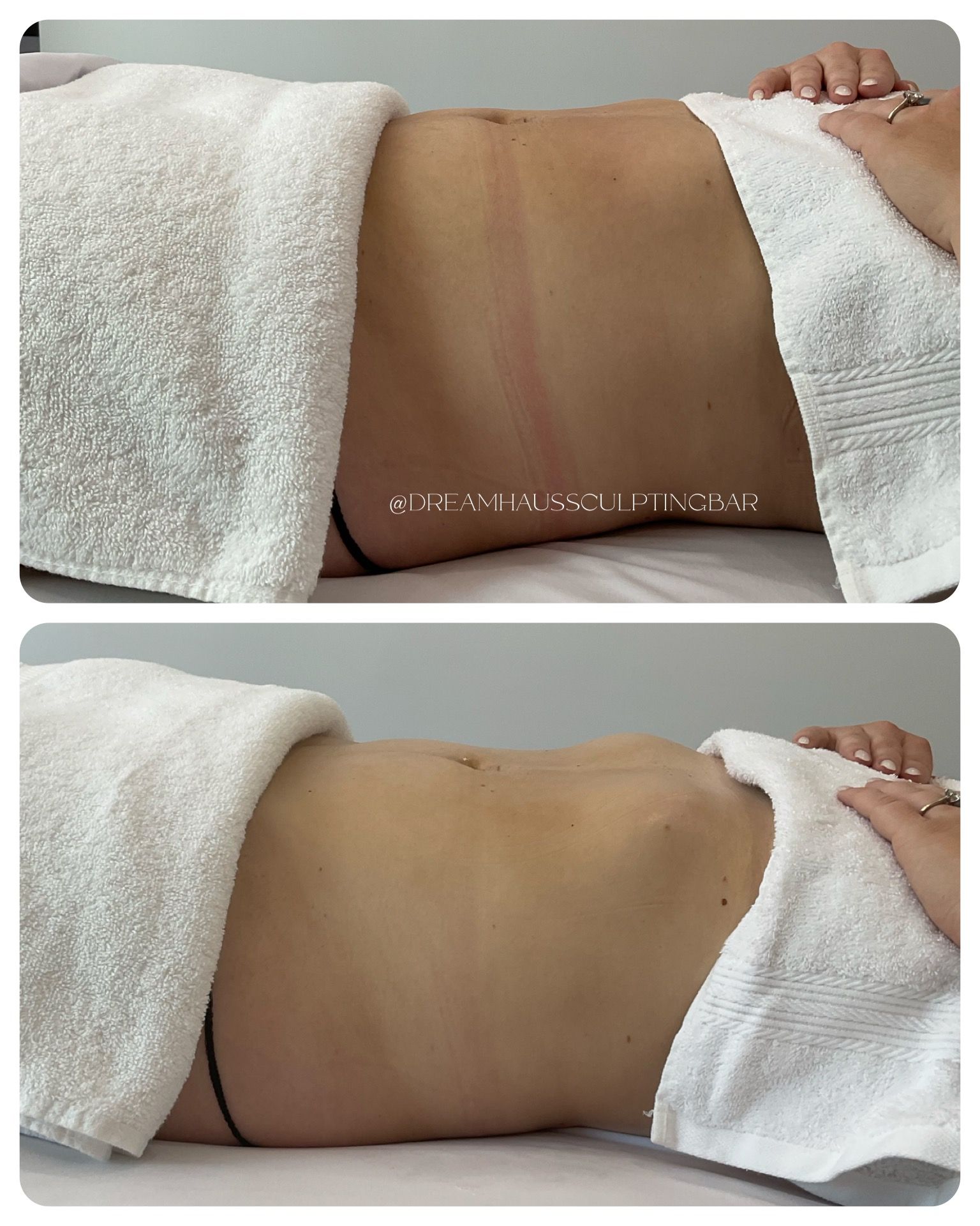 A woman is laying on a bed with a towel on her stomach.