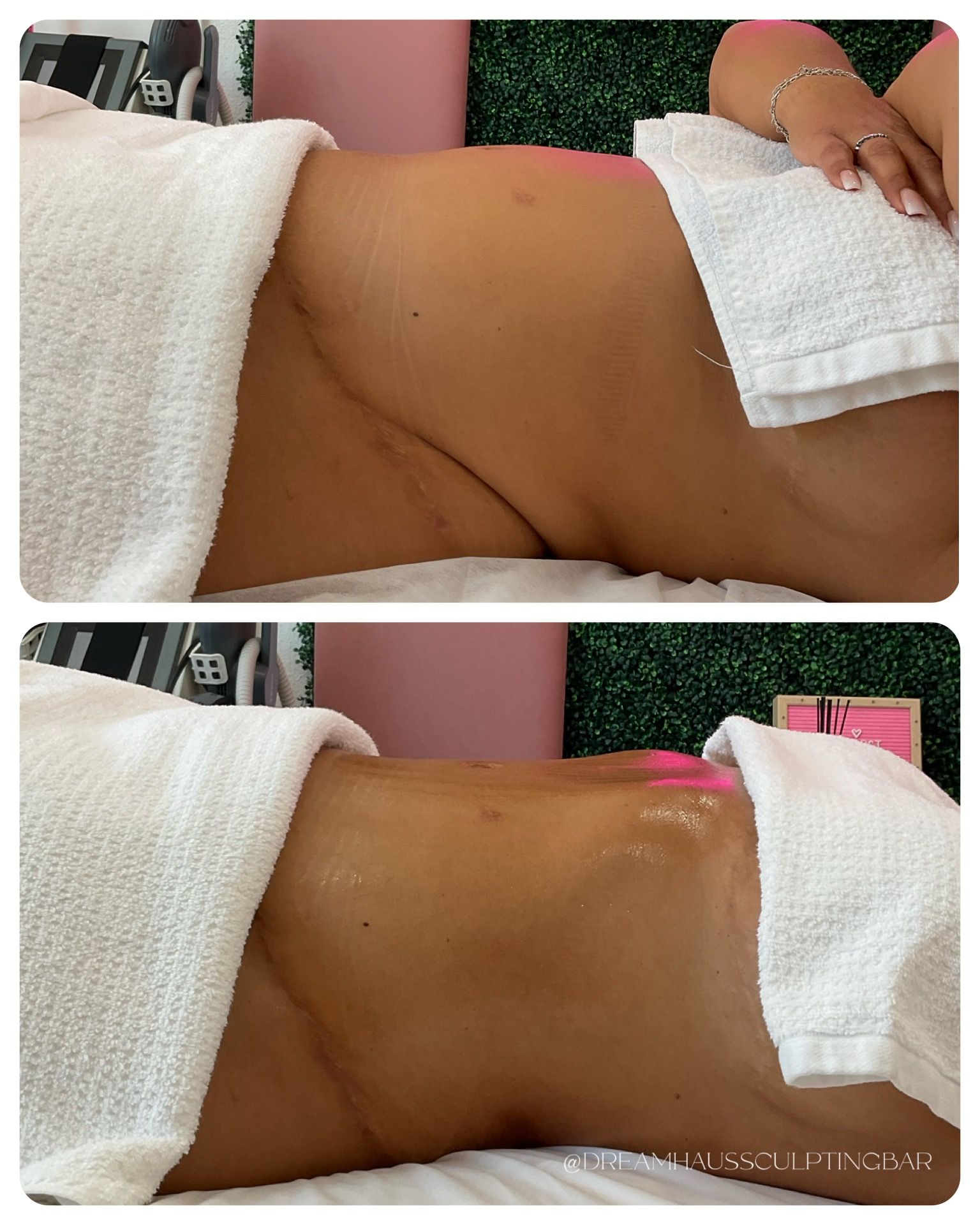 A woman laying on a bed with a towel on her stomach