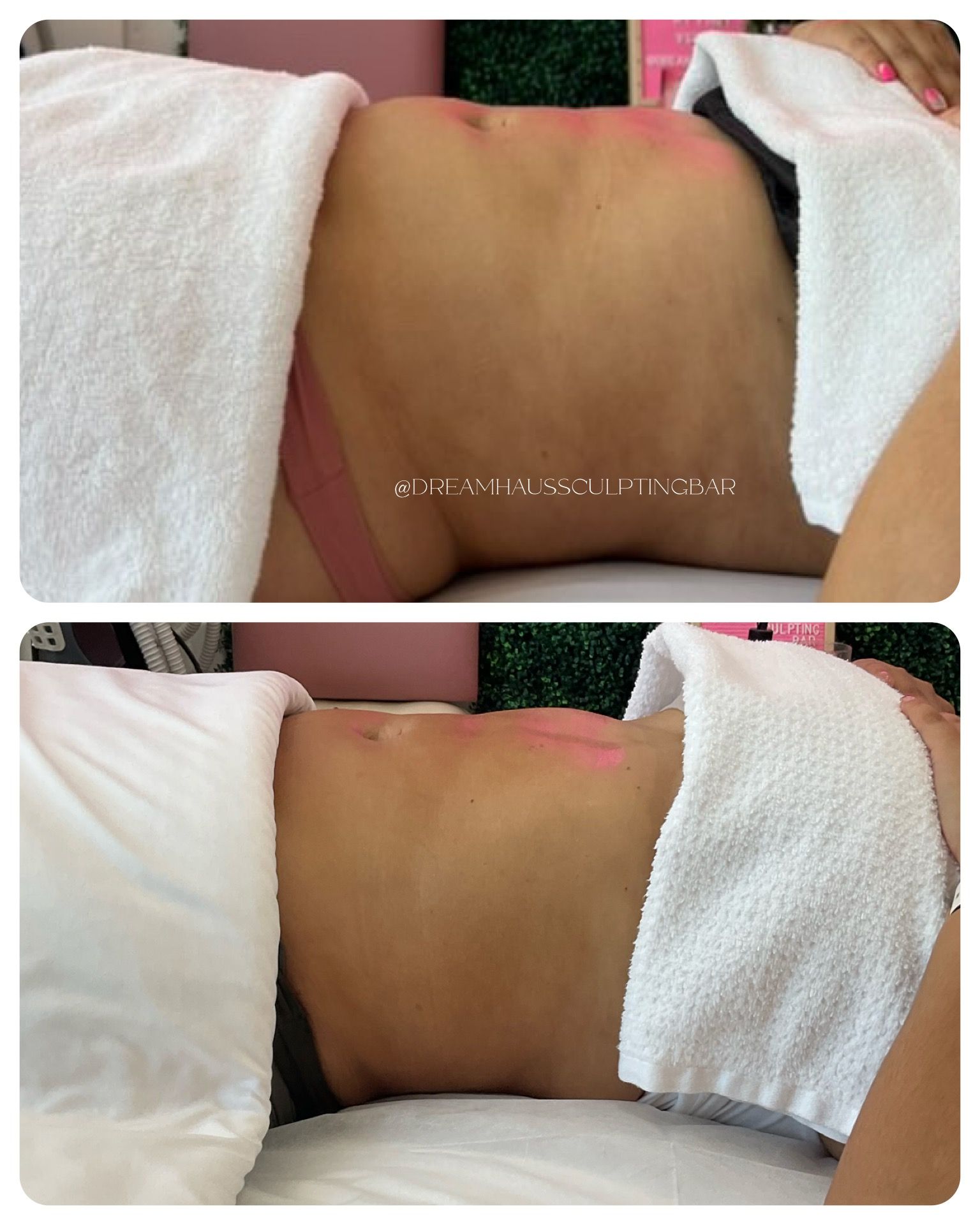 A woman is laying on a bed with a towel on her stomach.