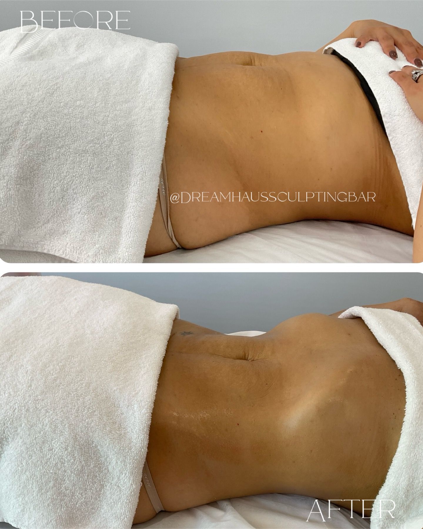 A before and after picture of a woman laying on a bed with a towel on her stomach.