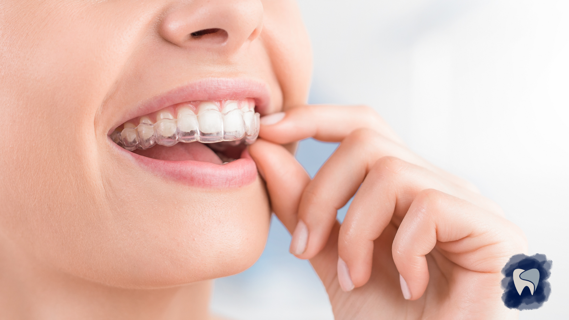 Woman inserting clear aligner into mouth.