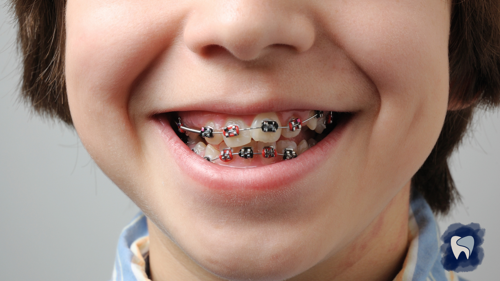 Close-up of a smiling person with orthodontic braces. Silver brackets and wires visible.