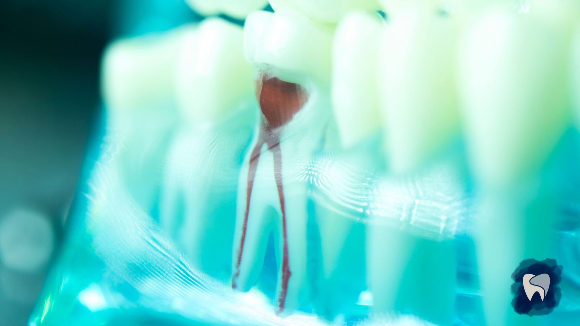Model of a tooth showing root canal, with red area inside and other teeth in a dental model, blue-toned lighting.