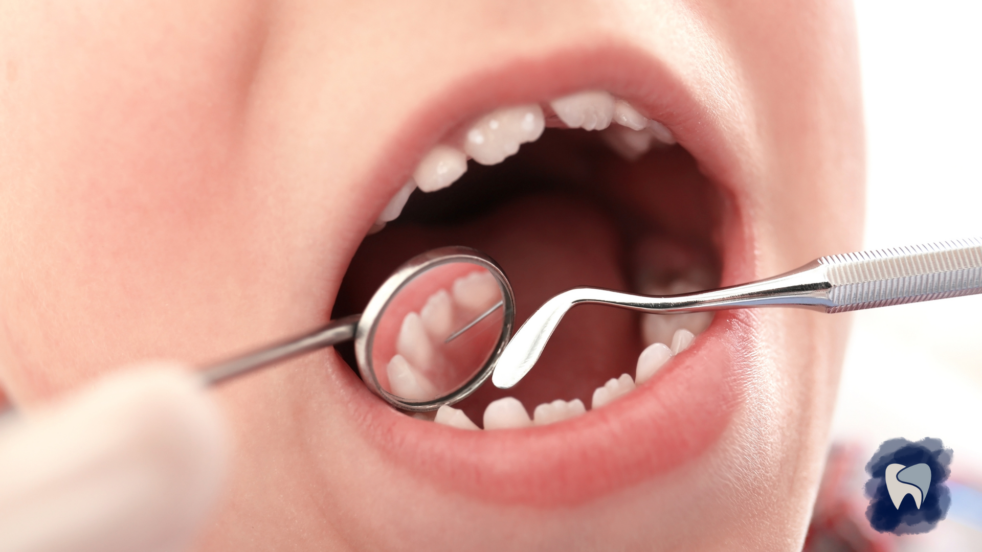 Child's mouth open with dental tools; mirror reflecting teeth, checkup in progress.