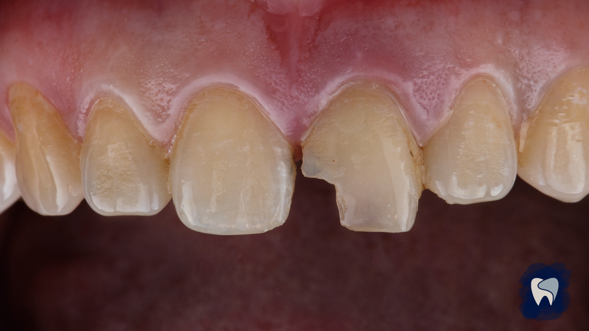 Close-up of teeth with a chipped front tooth. The teeth are off-white, and the gums are pink.