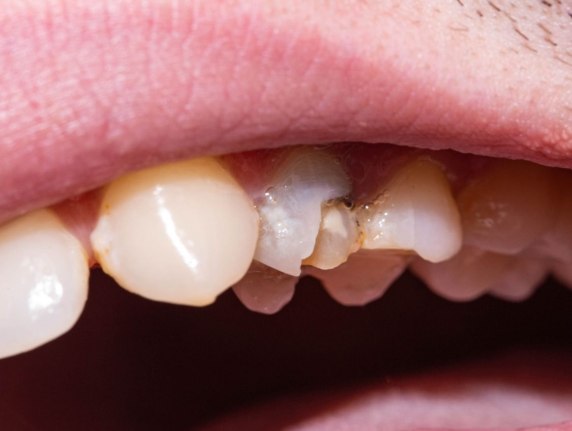 Close-up of a mouth with a chipped tooth, showing damaged enamel.