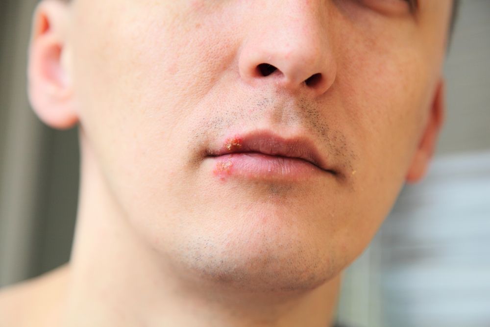 Man with a cold sore on his lower lip.