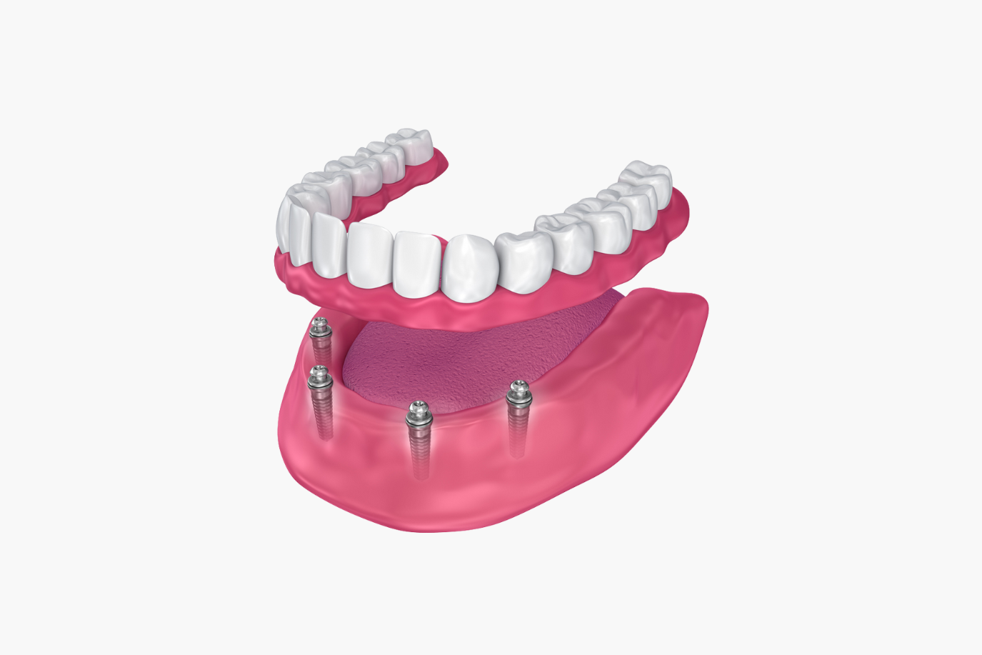 Dentures attached to dental implants in a pink gum.