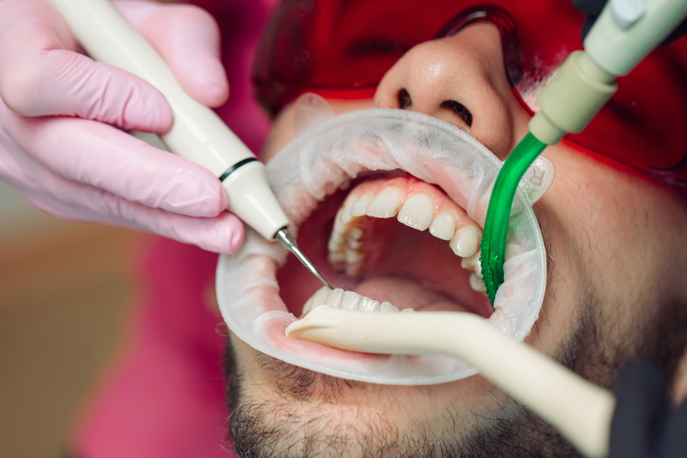 Person at dentist, mouth open, receiving dental cleaning. Tools and suction are in use.