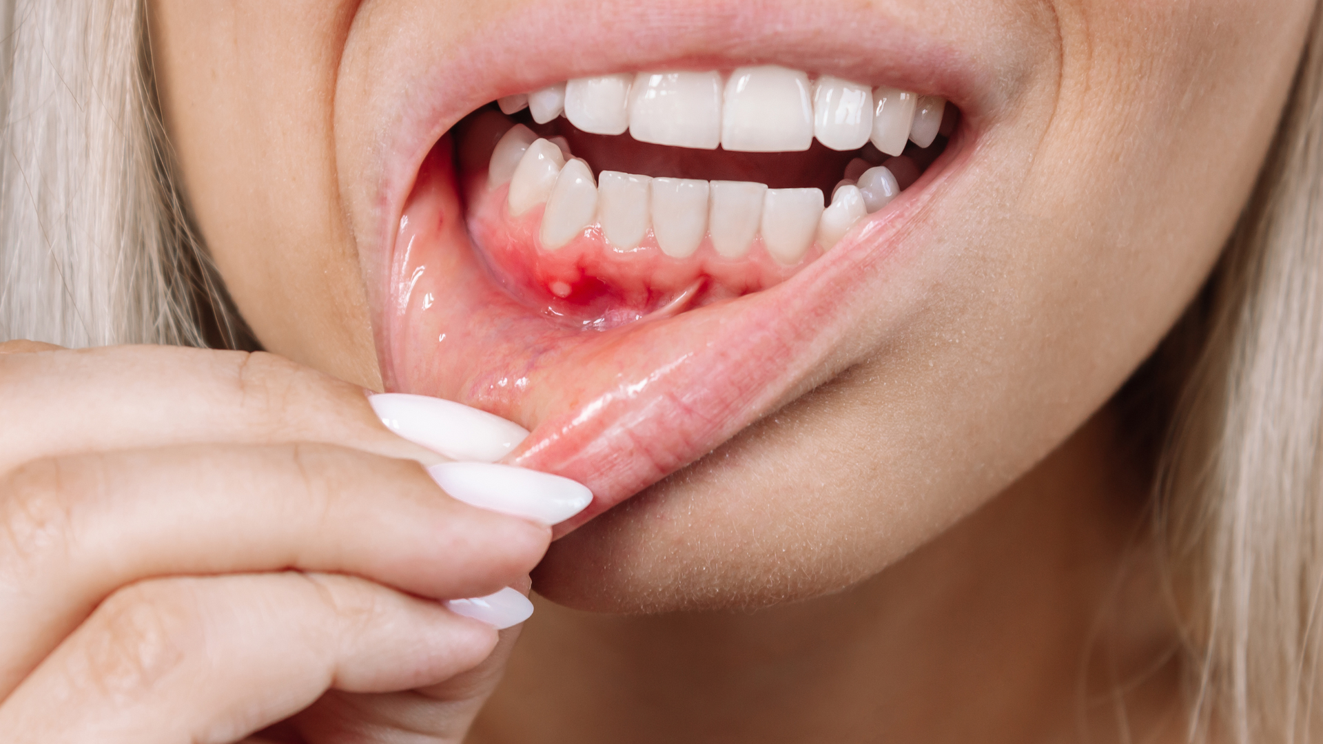 Woman's mouth open, showing inflamed gums. Fingers pull lip back. Red, sore spot visible.