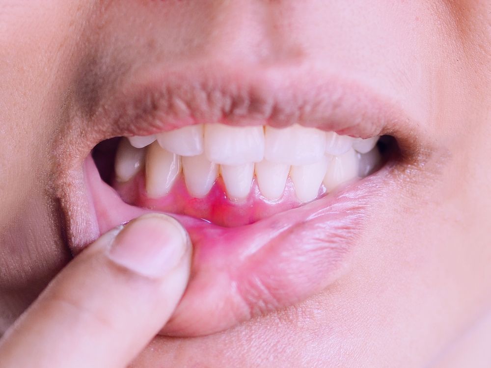 A person's mouth with inflamed, red gums, finger pointing at the affected area.