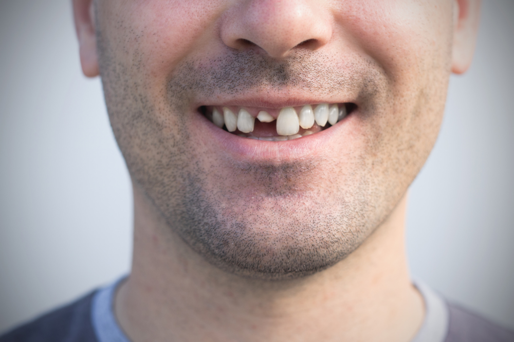 Close-up of a smiling man with a missing front tooth.
