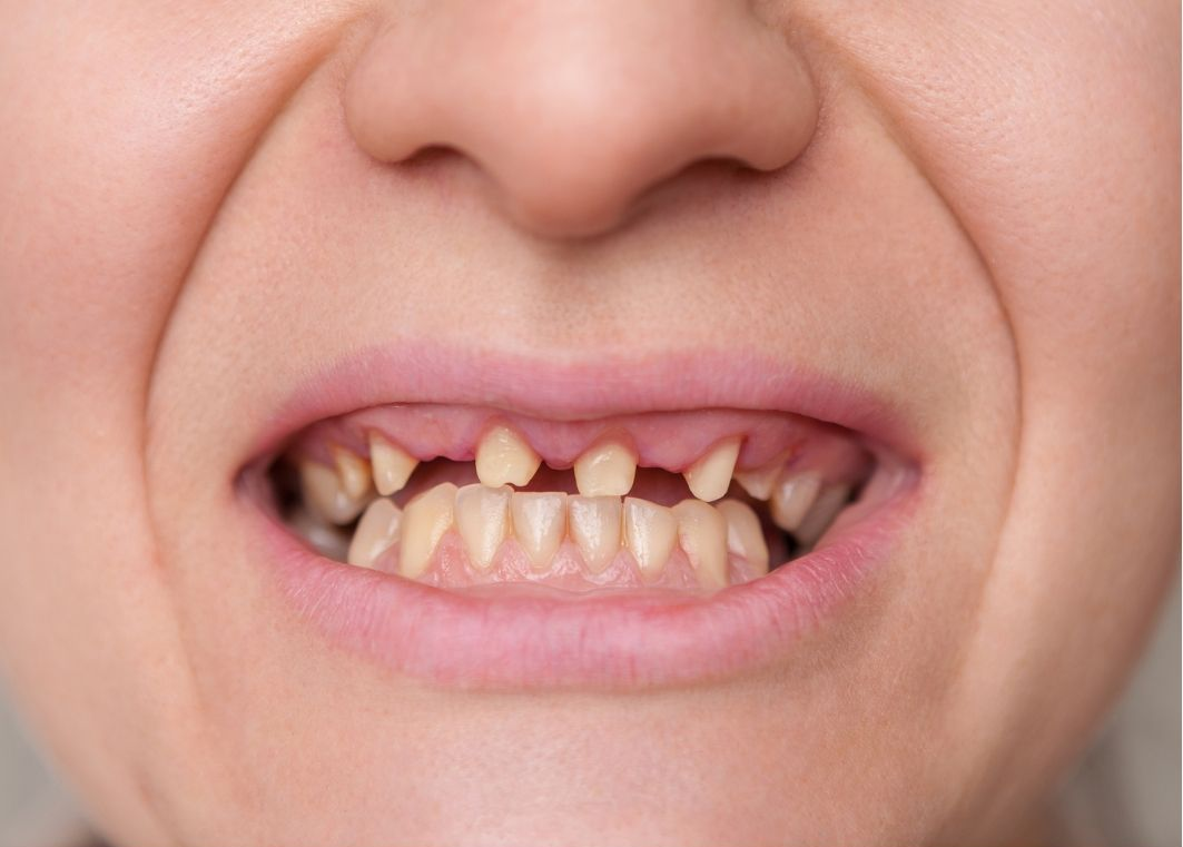 Close-up of a person's mouth, showing badly damaged, yellow teeth, and a grimace.