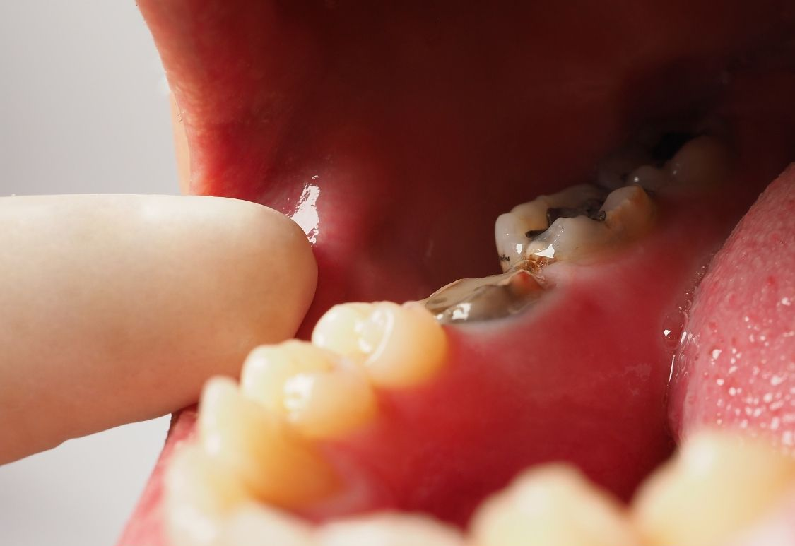 Close-up of a mouth with visible teeth. A finger points at a molar with decay and fillings.