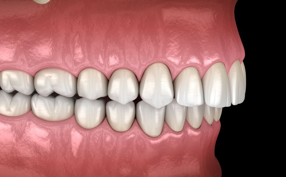 Side view of teeth with slight misalignment, set against a black background. Pink gums and white teeth are visible.