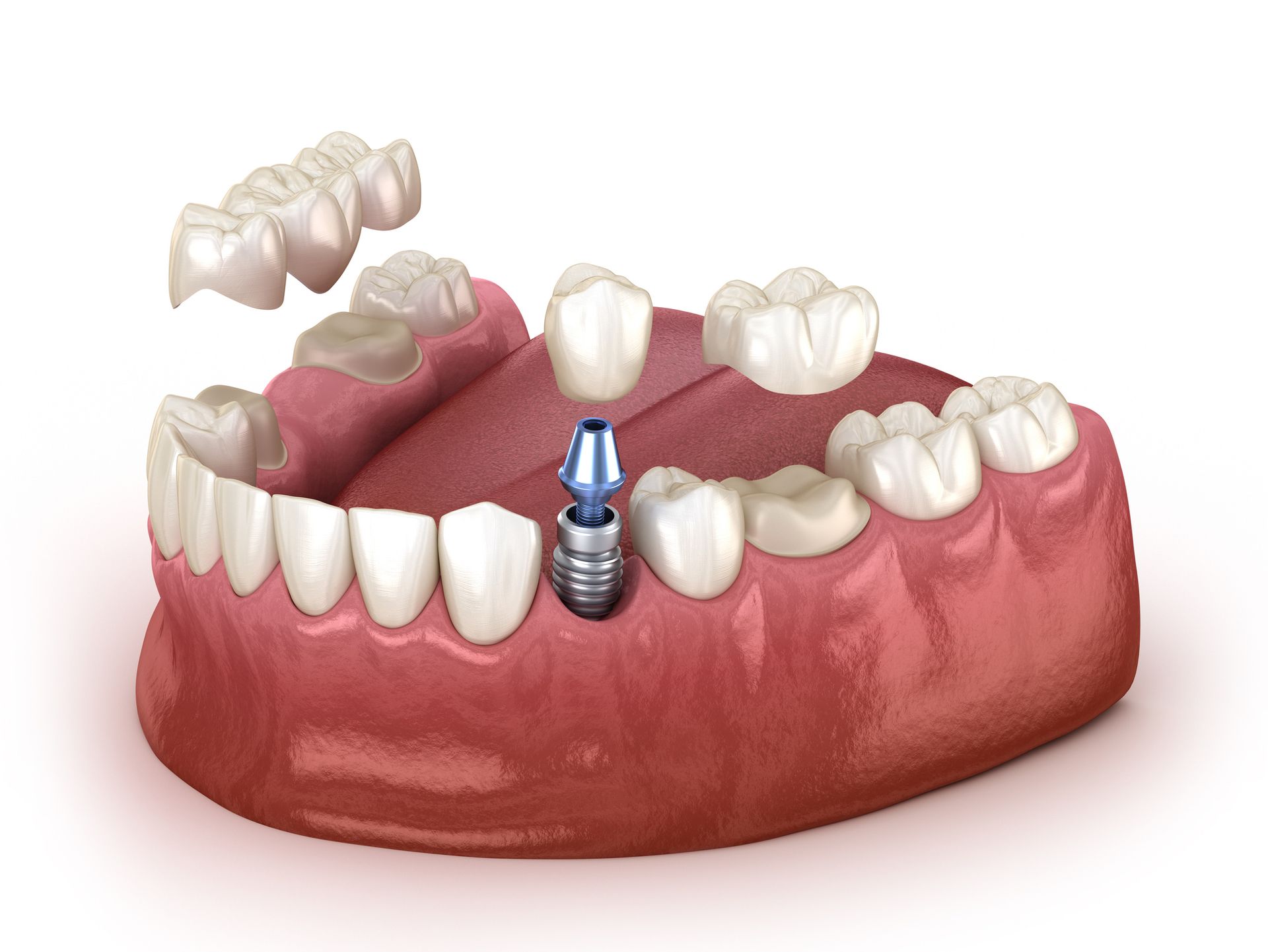 A computer generated image of a dental implant in a mouth.