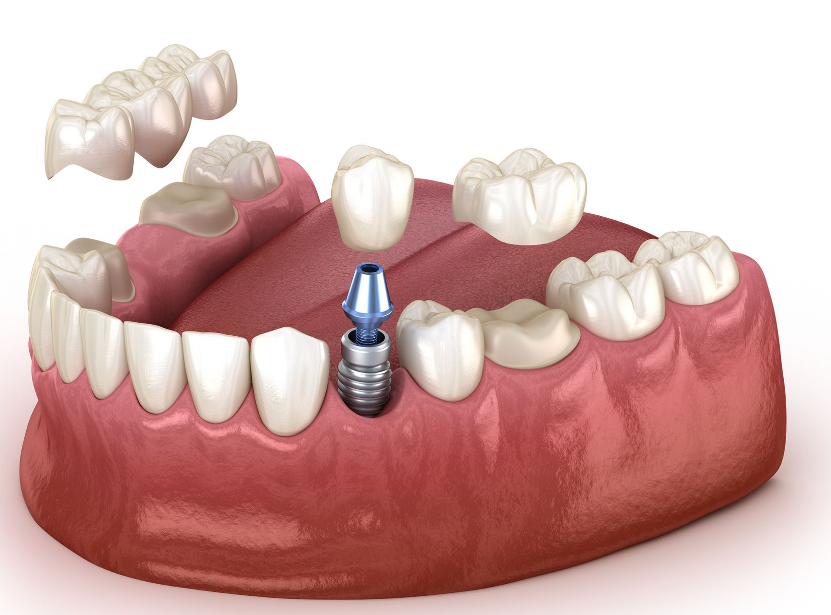 A computer generated image of a dental implant in a mouth.