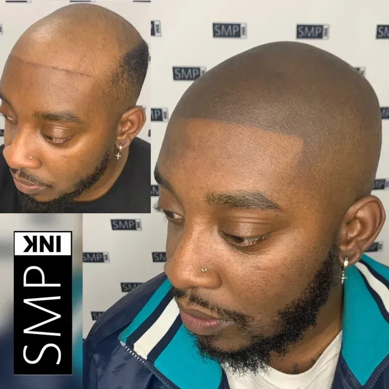 A man before and after receiving SMP from SMP INK