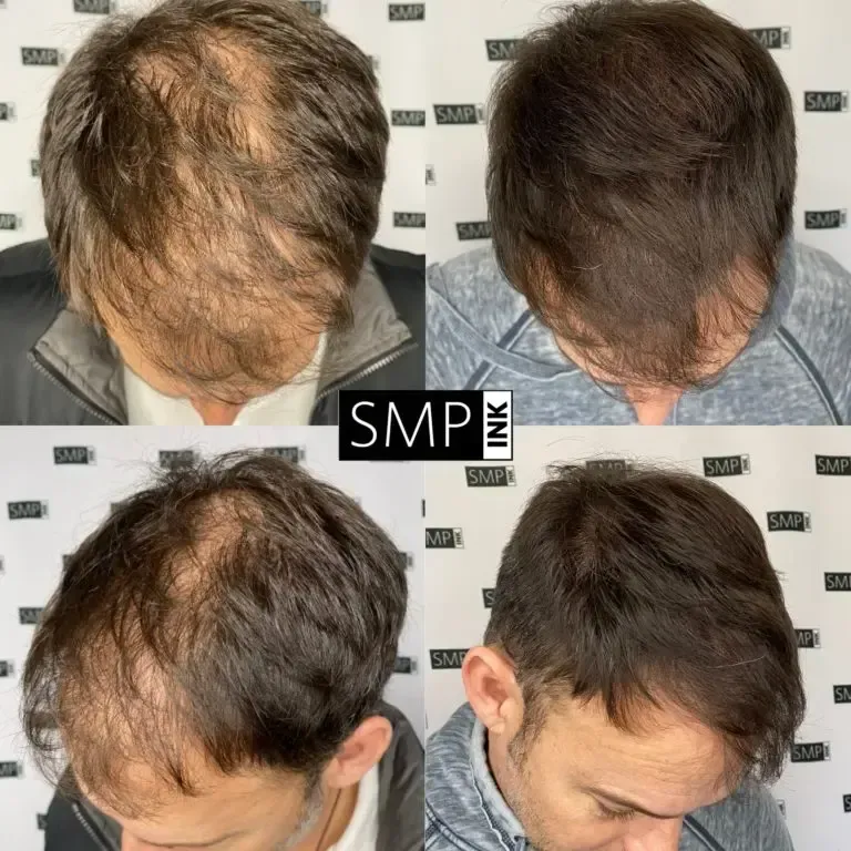 Four pictures of a man 's head before and after receiving SMP from SMP INK