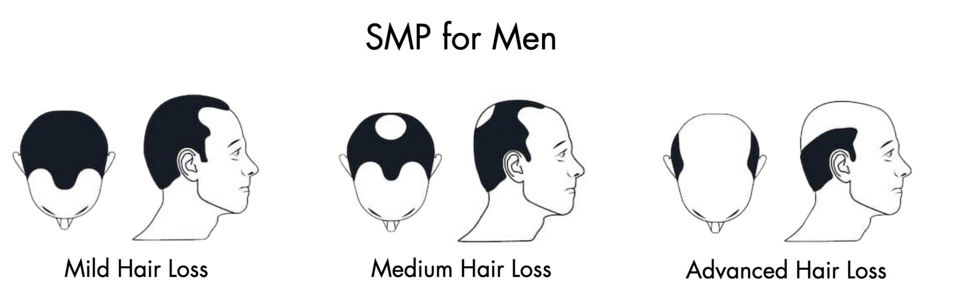 A diagram showing different types of hair loss for men