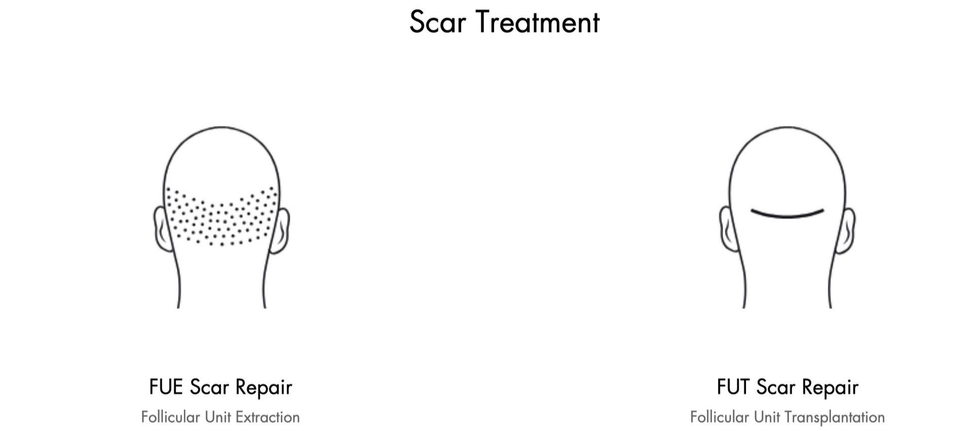 A black and white drawing of a person 's head with a SMP scar treatment.