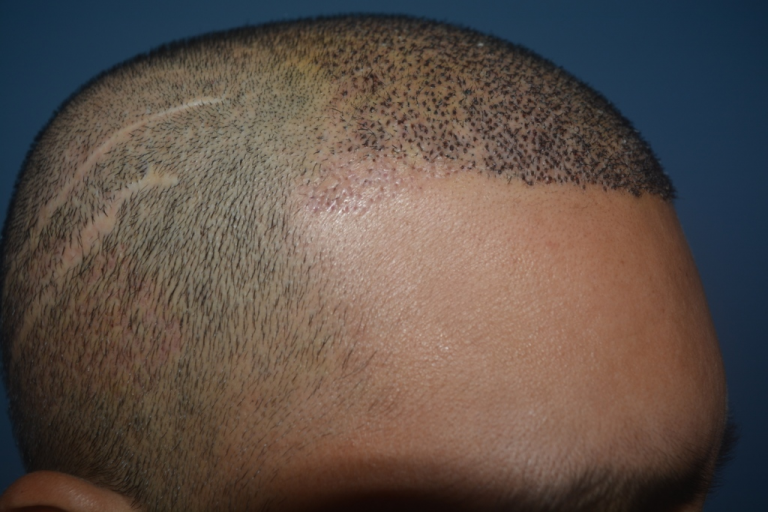 A close up of a person 's head with a scar on it.