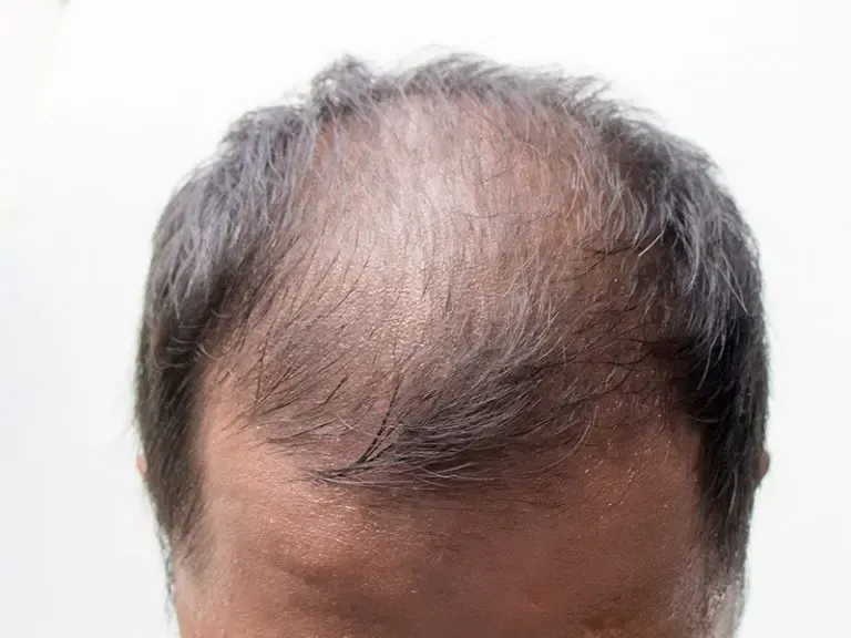 A man with a bald head is looking at the camera.