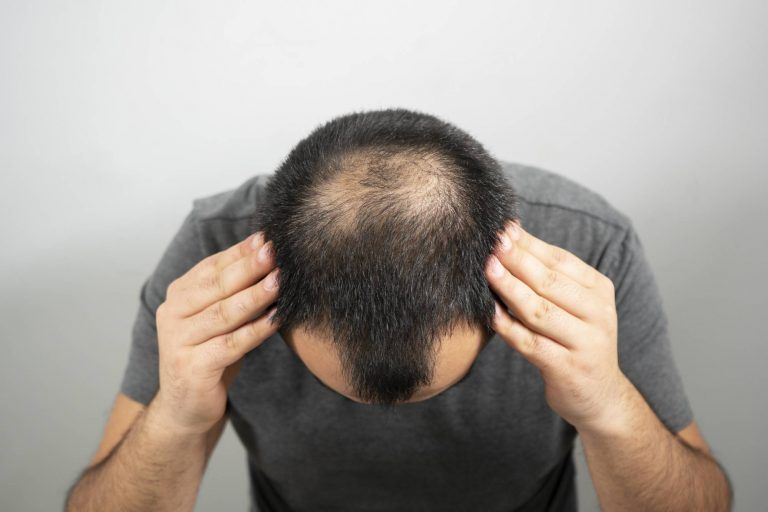 A man is looking at his bald head.