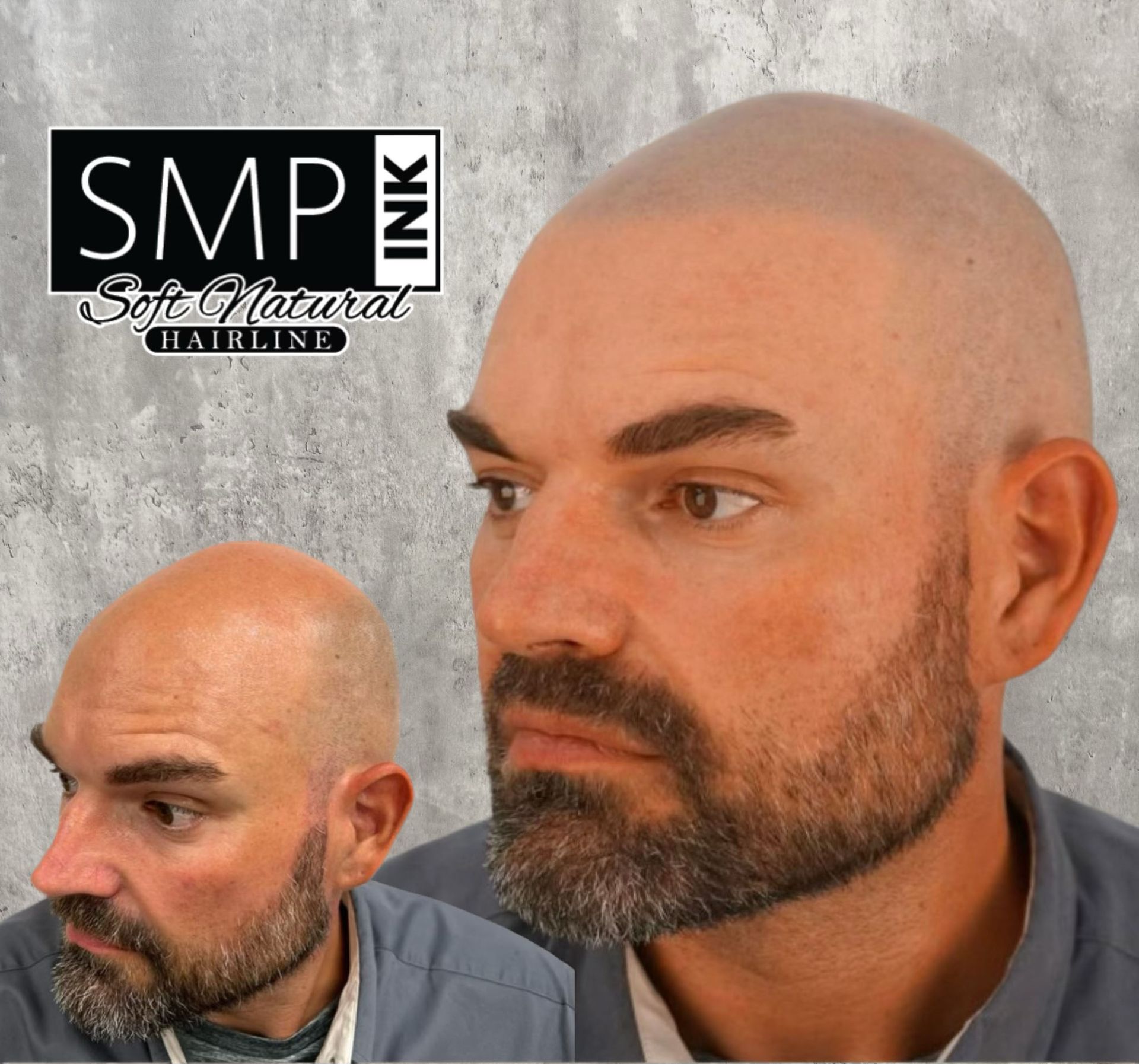 before after smp hairline restoration
