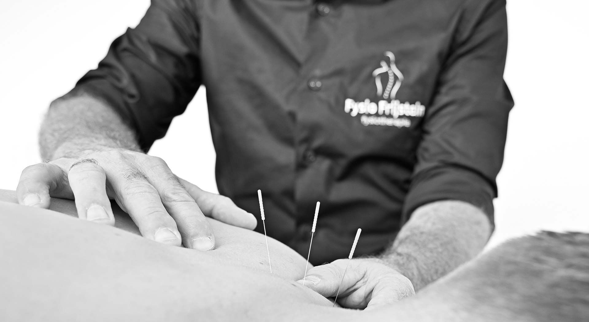 Dry needling