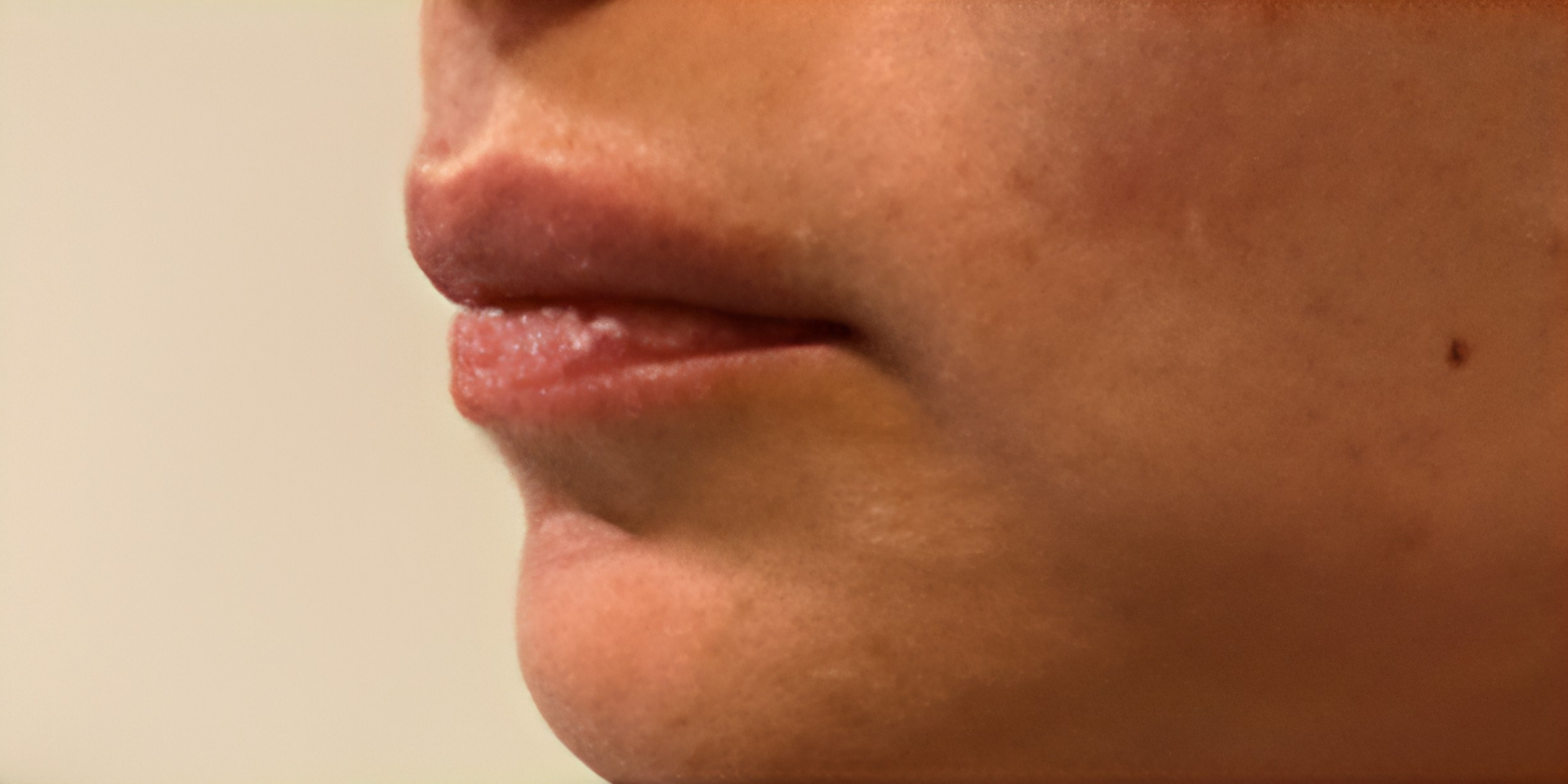 Before IPL Skin Rejuvenation