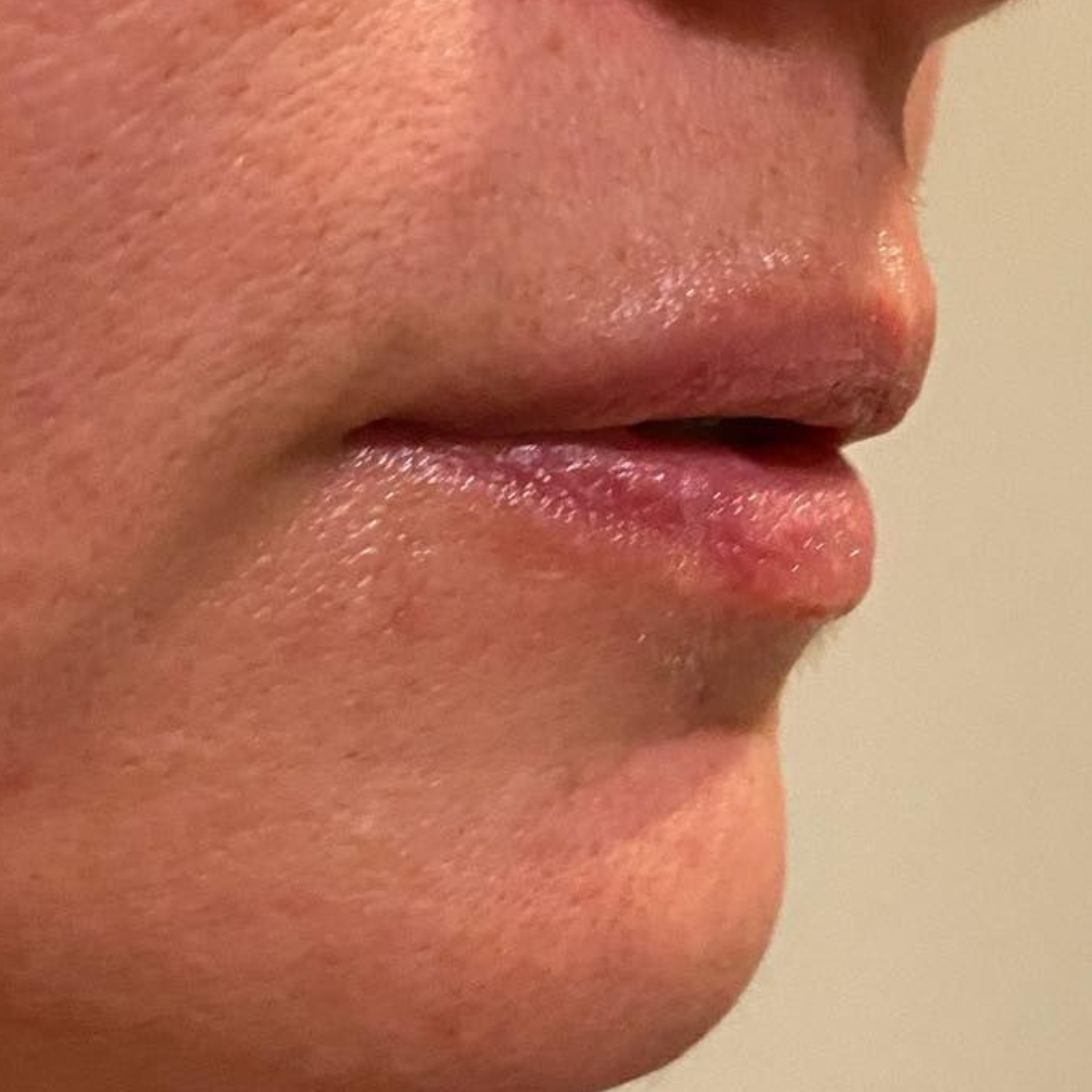 Before HydraFacial Treatments