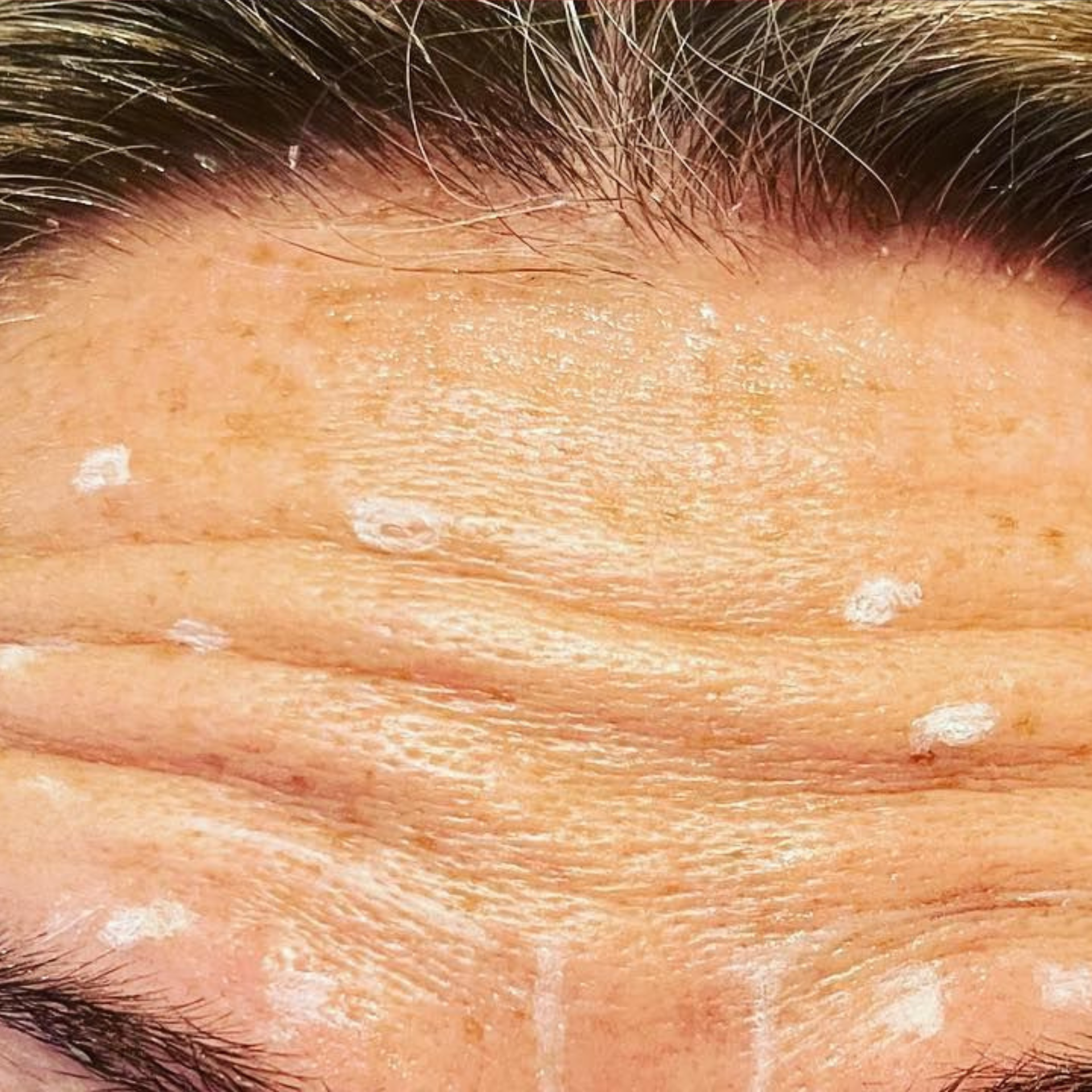 Before IPL Skin Rejuvenation