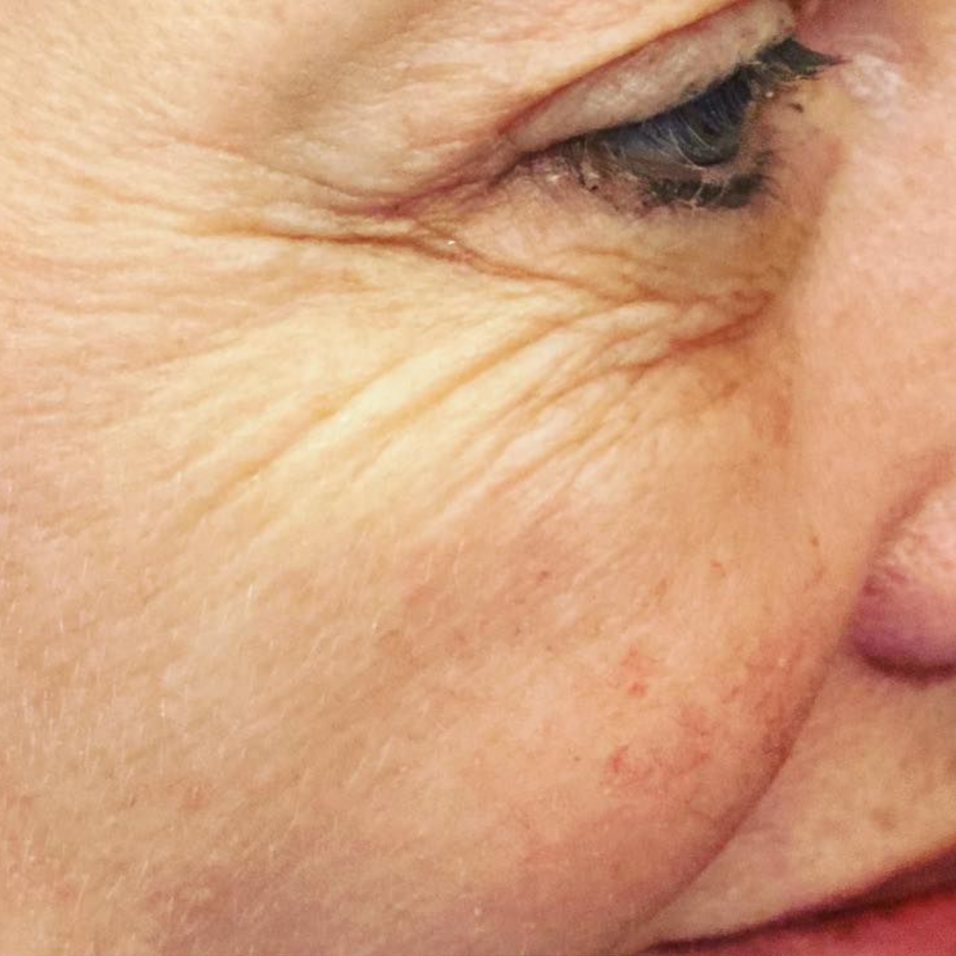Before IPL Skin Rejuvenation