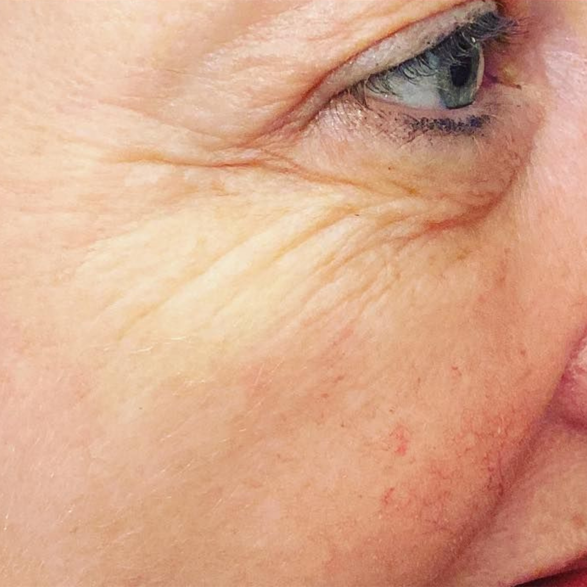 After IPL Skin Rejuvenation