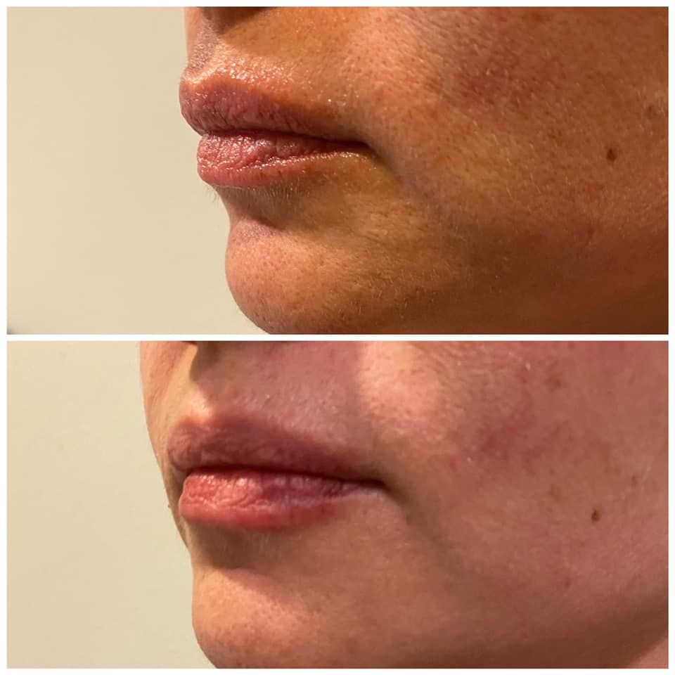 Side-by-side close-ups of a lower face with chapped lips and cheek blemishes before and after